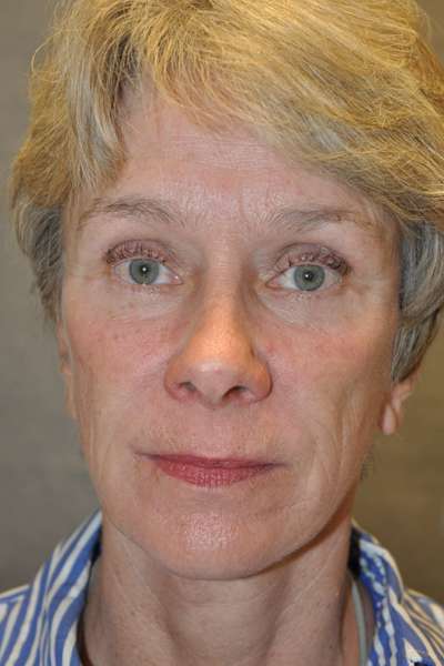 Eyelid Lift Case 5138 After Photo Eyelid Lift