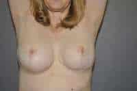 Breast Reduction