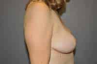 Breast Reduction