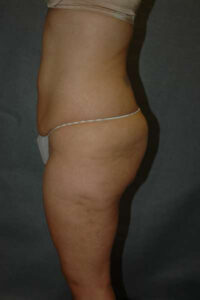 Belt Lipectomy