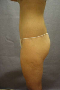 Belt Lipectomy