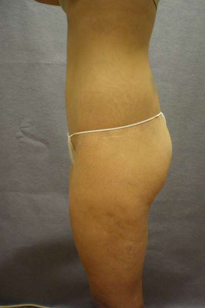 Belt Lipectomy