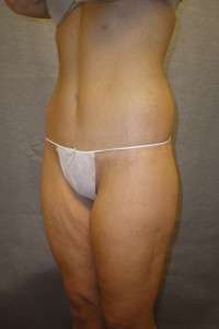 Belt Lipectomy