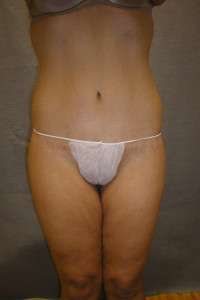 Belt Lipectomy