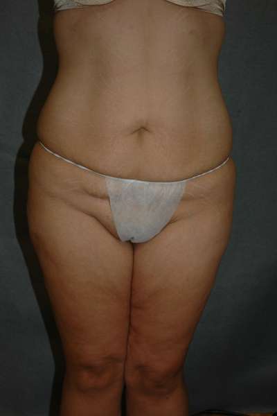 Belt Lipectomy Case 5224 Before Photo Belt Lipectomy