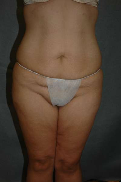 Belt Lipectomy