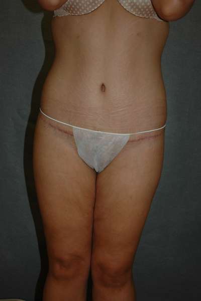 Belt Lipectomy Case 5224 After Photo Belt Lipectomy