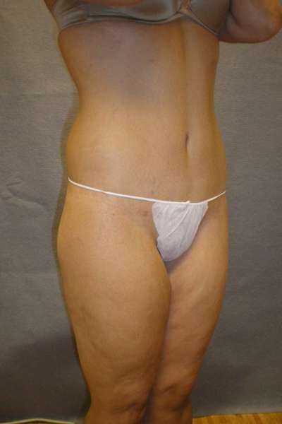 Belt Lipectomy