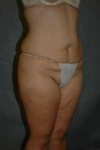 Belt Lipectomy