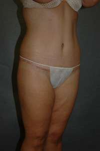 Belt Lipectomy