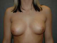 Breast Augmentation