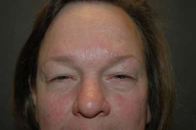 Eyelid Lift Case 5274 Before Photo Eyelid Lift