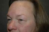 Eyelid Lift