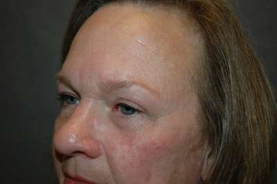 Eyelid Lift