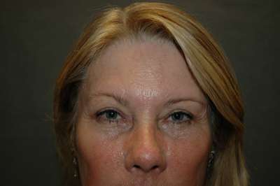 Eyelid Lift Case 5315 After Photo Eyelid Lift