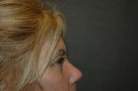 Eyelid Lift
