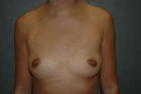 Breast Augmentation