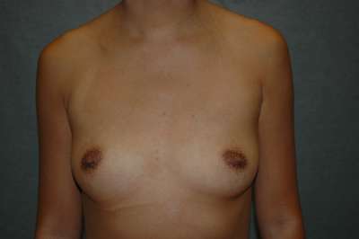 Breast Augmentation Case 5276 Before Photo Breast Augmentation