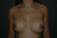 Breast Augmentation