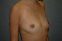 Breast Augmentation