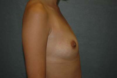 Breast Augmentation