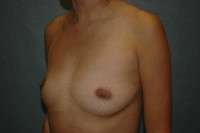 Breast Augmentation