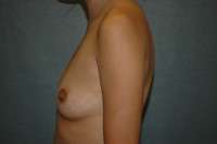 Breast Augmentation