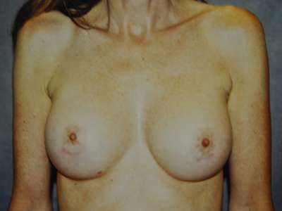 Breast Augmentation