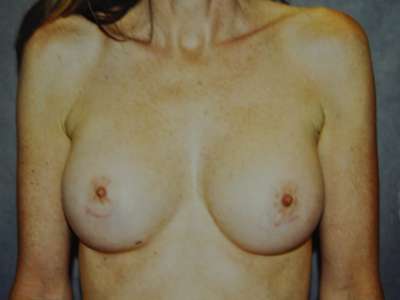 Breast Augmentation Case 5308 Before Photo Breast Augmentation