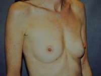 Breast Augmentation