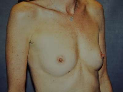 Breast Augmentation