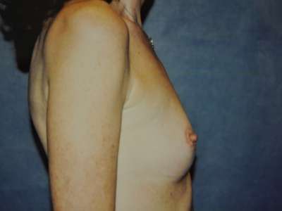 Breast Augmentation