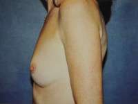 Breast Augmentation