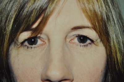 Eyelid Lift Case 5067 Before Photo Eyelid Lift