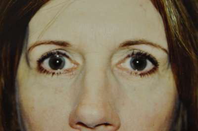 Eyelid Lift Case 5067 After Photo Eyelid Lift