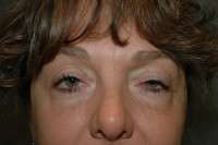 Eyelid Lift