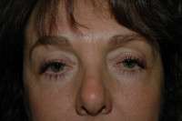 Eyelid Lift