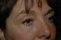 Eyelid Lift