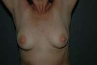 Breast Augmentation