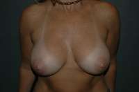 Breast Augmentation