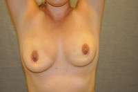 Breast Augmentation