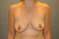 Breast Augmentation