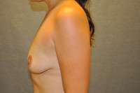 Breast Augmentation