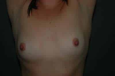 Breast Augmentation