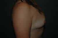 Breast Augmentation