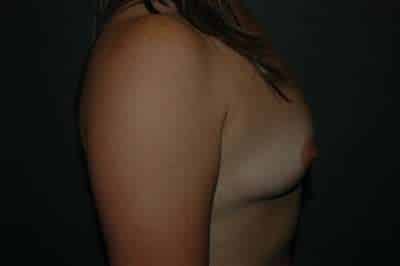 Breast Augmentation
