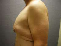 Male Belt Lipectomy