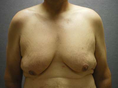 Male Belt Lipectomy Case 4662 Before Photo Male Belt Lipectomy