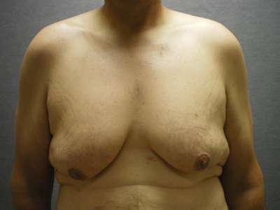 Belt Lipectomy