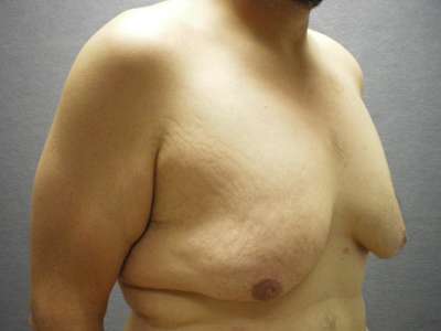 Male Belt Lipectomy